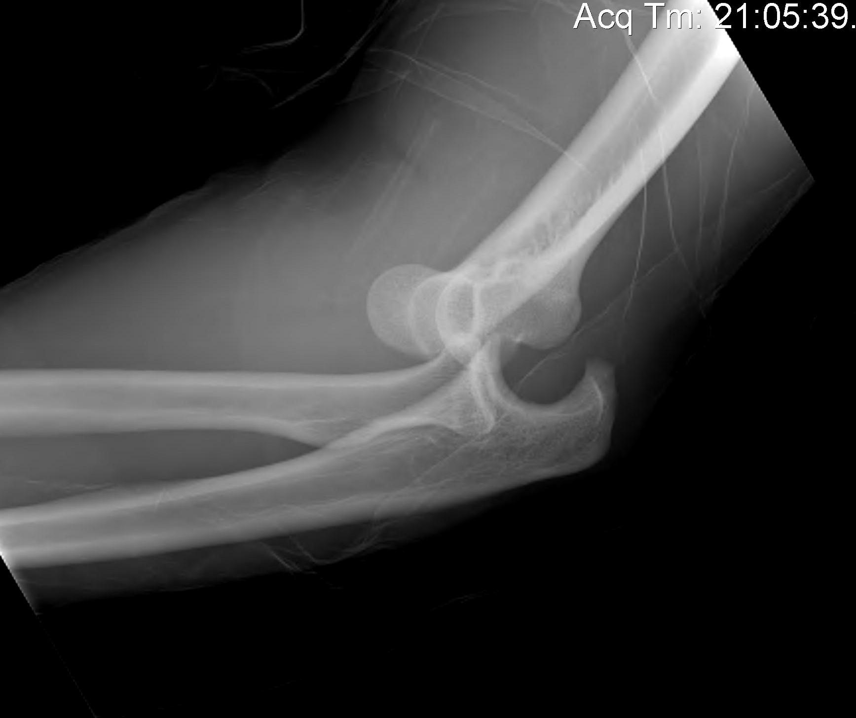 Simple Elbow Dislocation